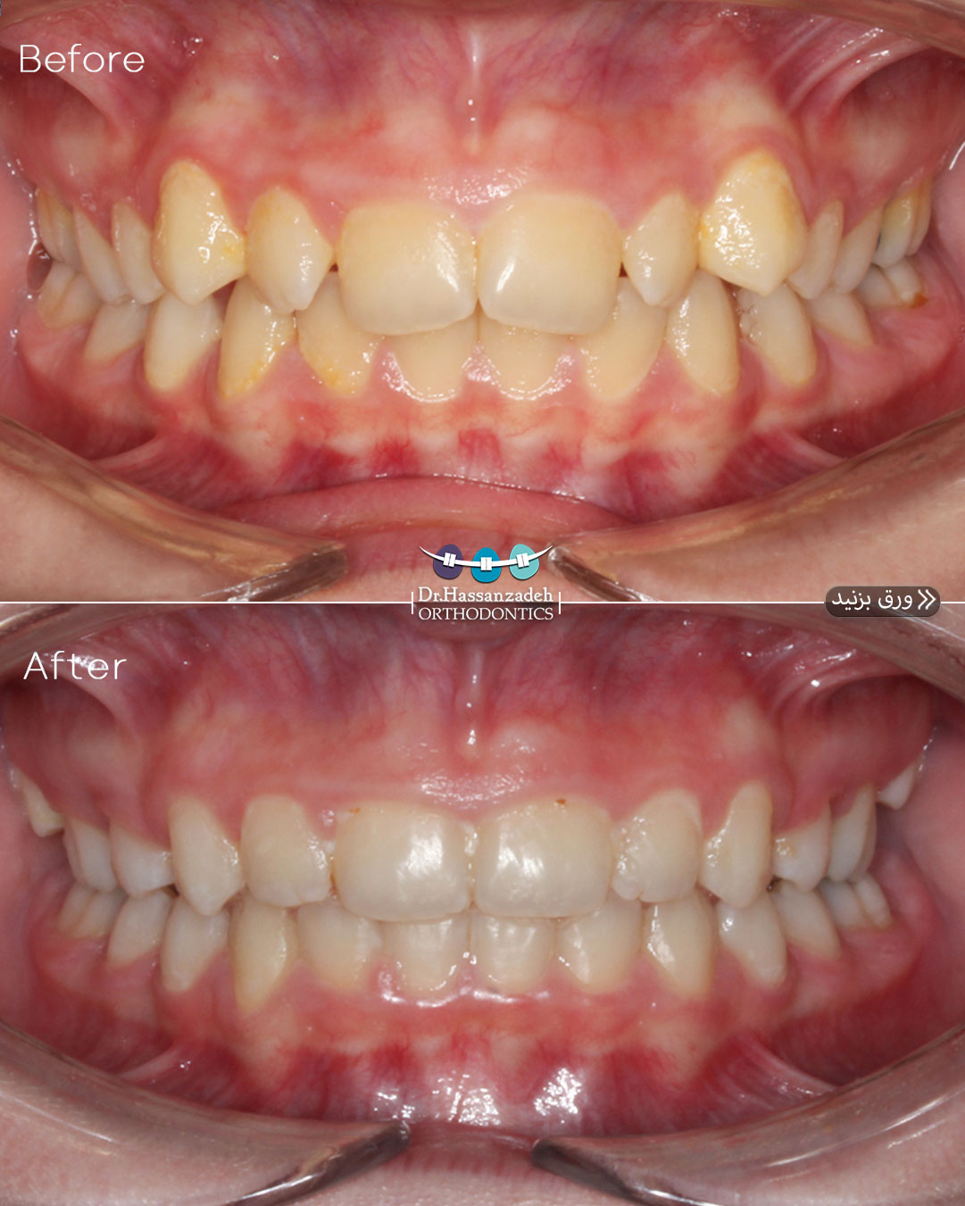 قبل و بعد از درمان اورتودنسی