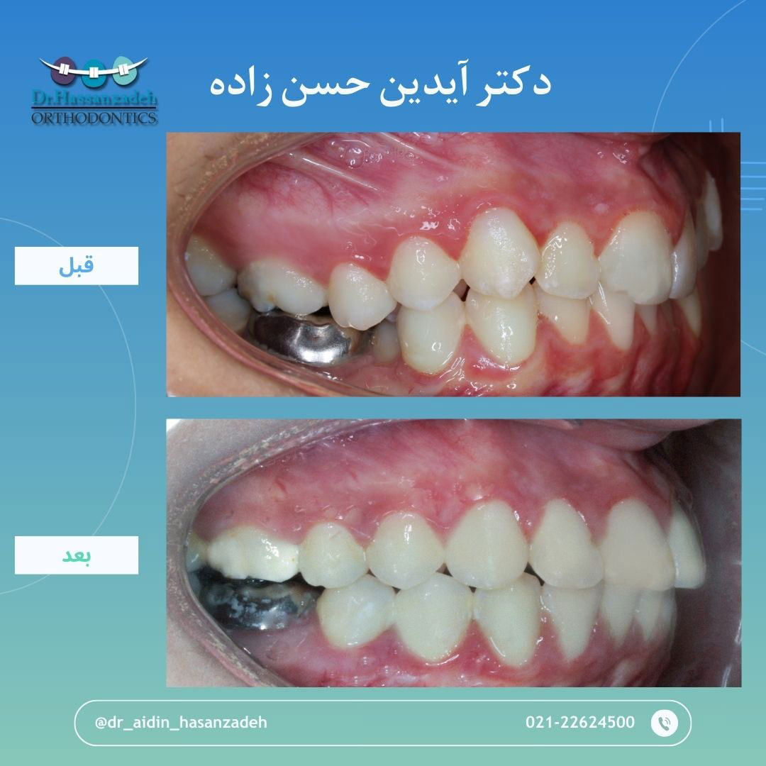 قبل و بعد از درمان اورتودنسی