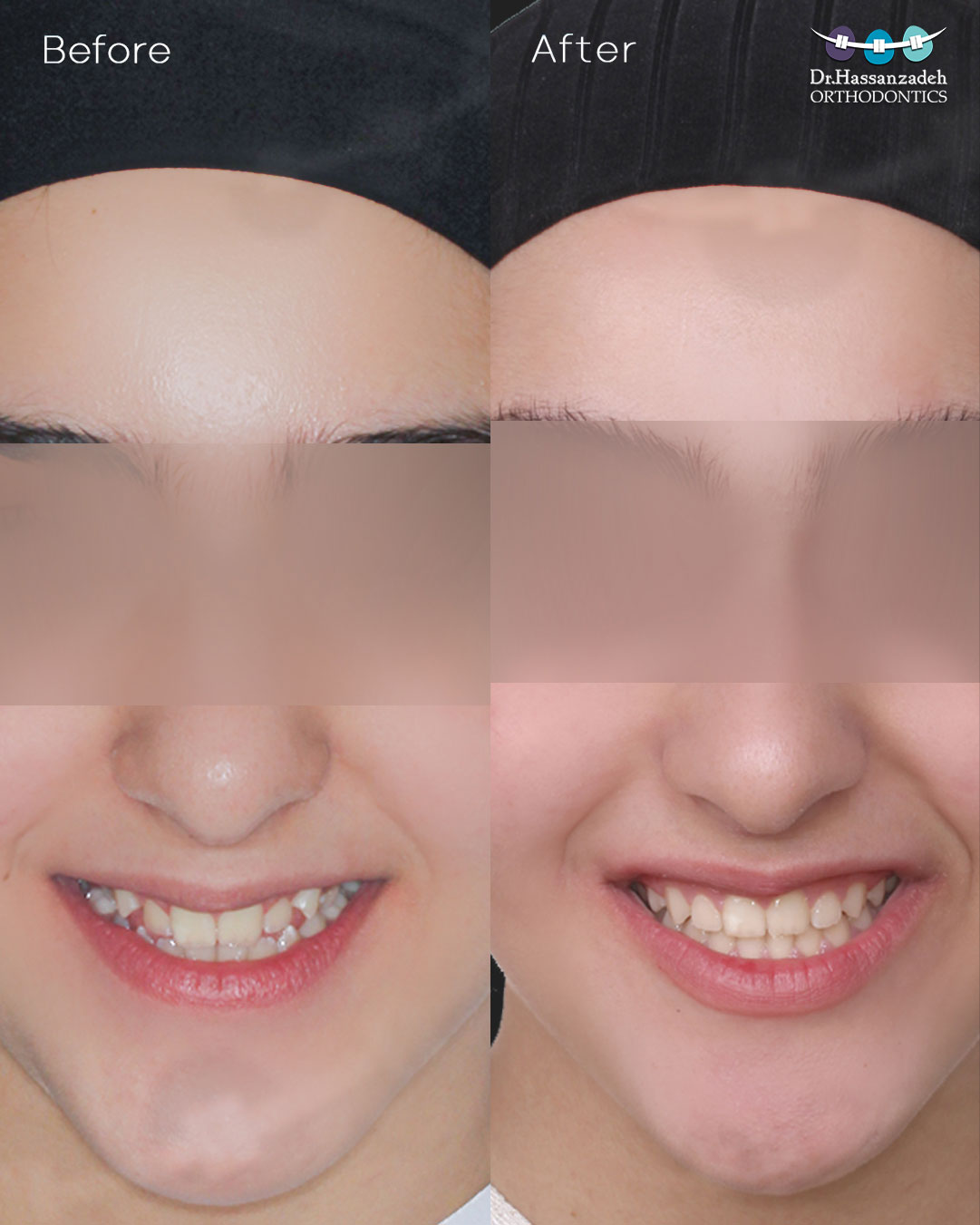 قبل و بعد از درمان