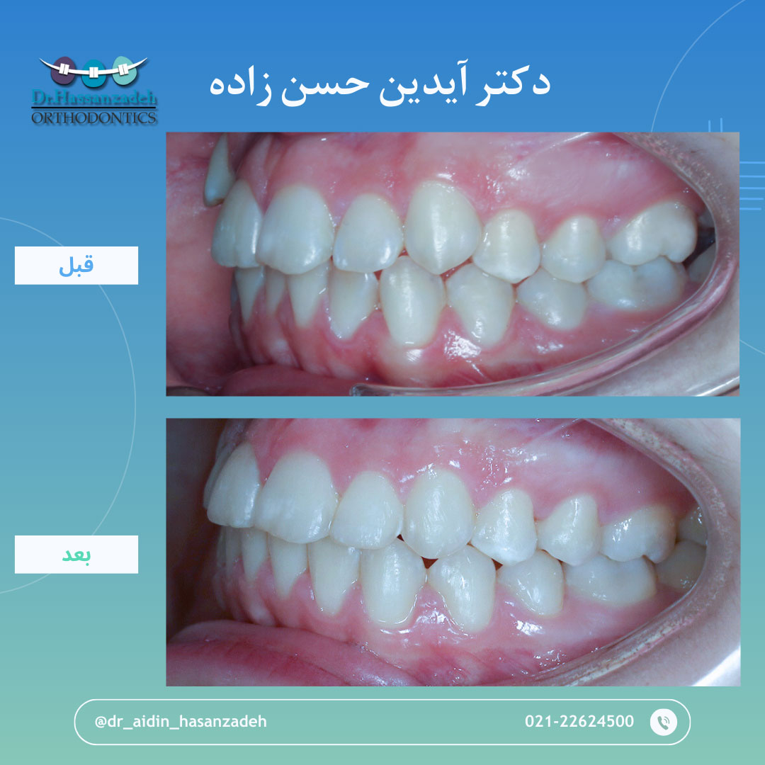 قبل و بعد از درمان اورتودنسی