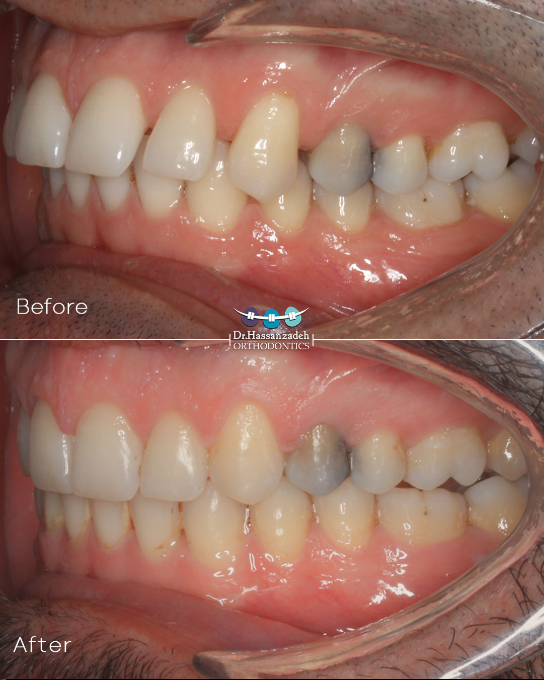 قبل و بعد از درمان اورتودنسی