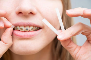 از سیم‌ها تا نگهدارنده‌ها: همه چیز درباره فرآیند ارتودنسی