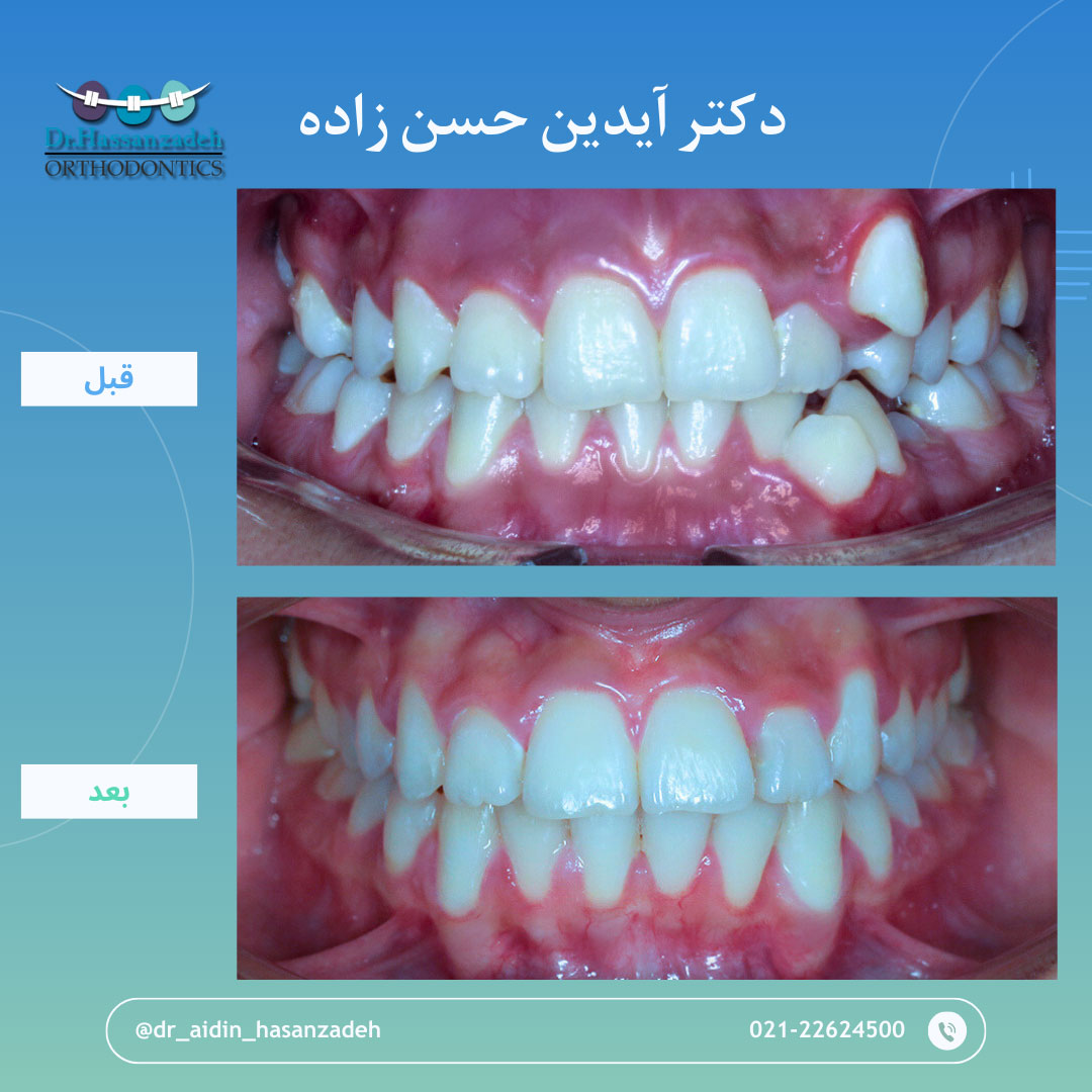 قبل و بعد از درمان اورتودنسی