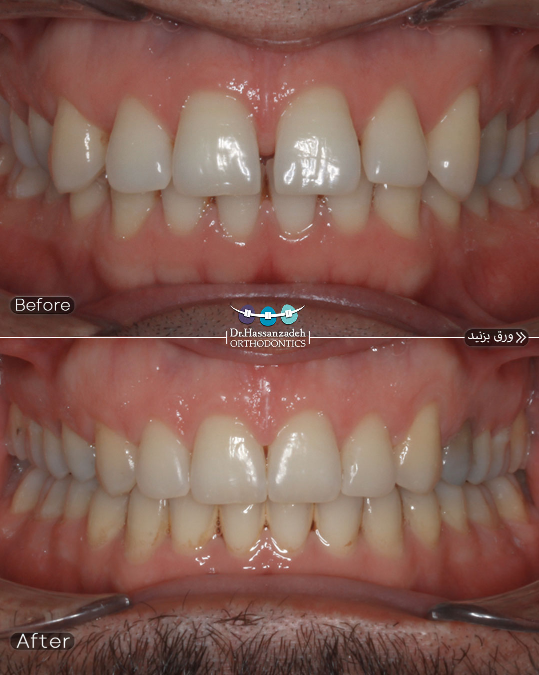 قبل و بعد از درمان اورتودنسی
