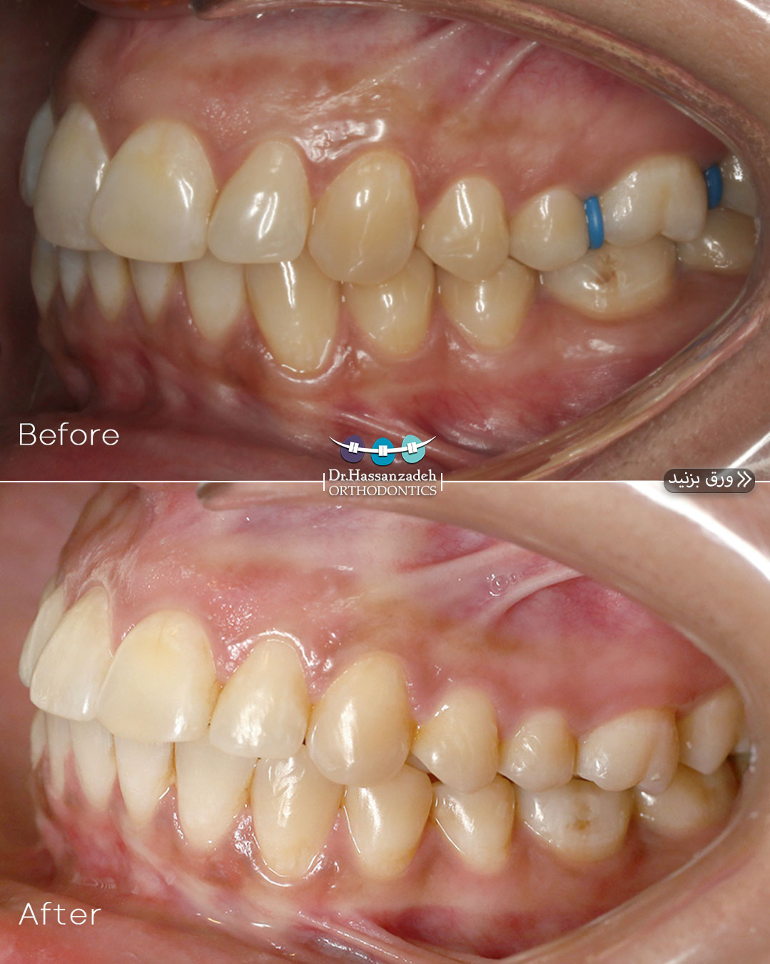 قبل و بعد از درمان اورتودنسی