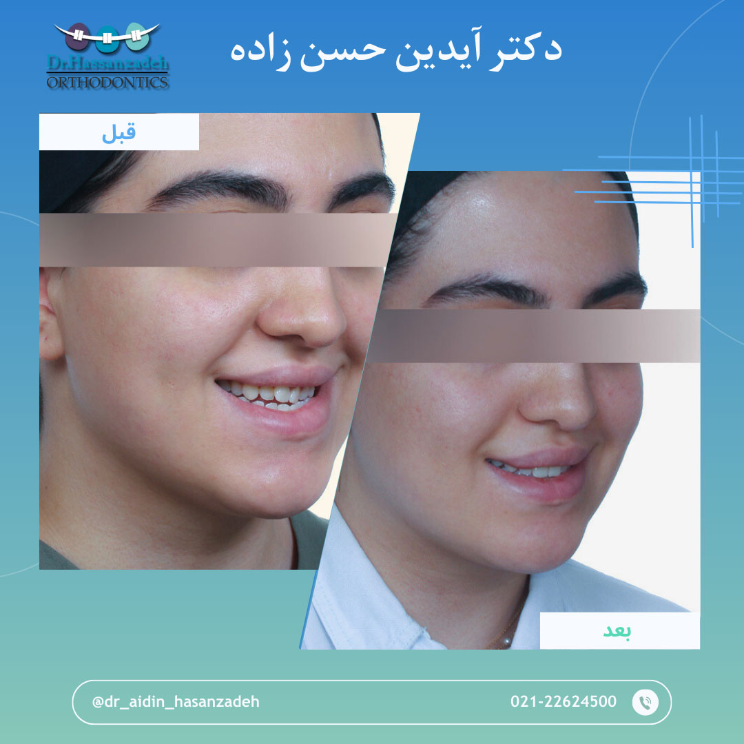 قبل و بعد از درمان اورتودنسی