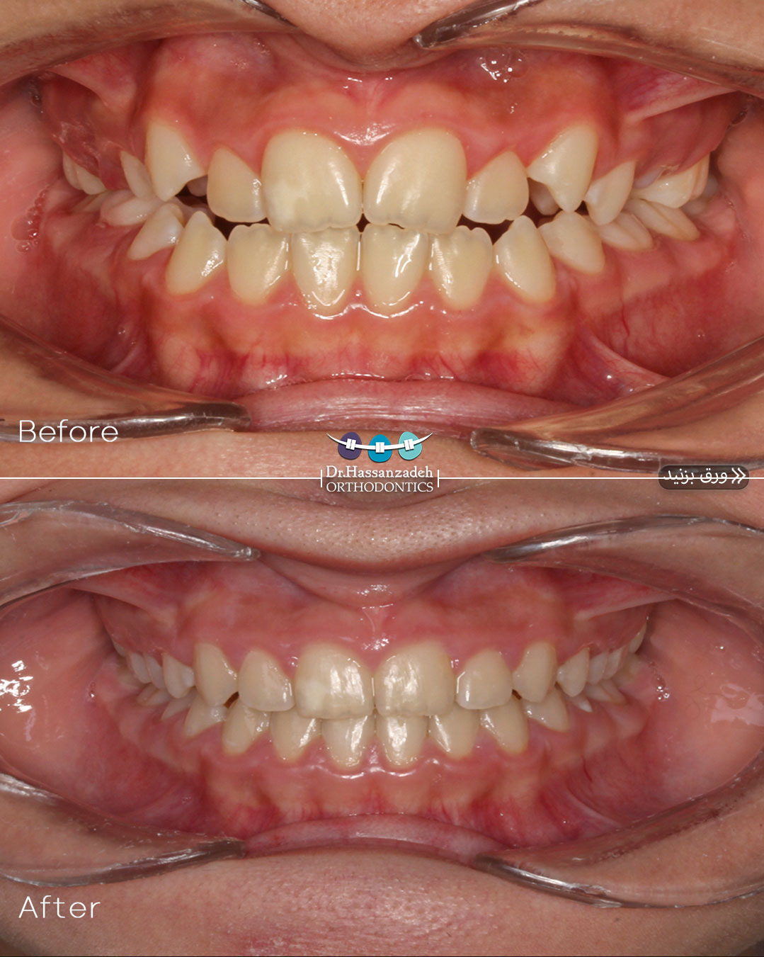 قبل و بعد از درمان اورتودنسی