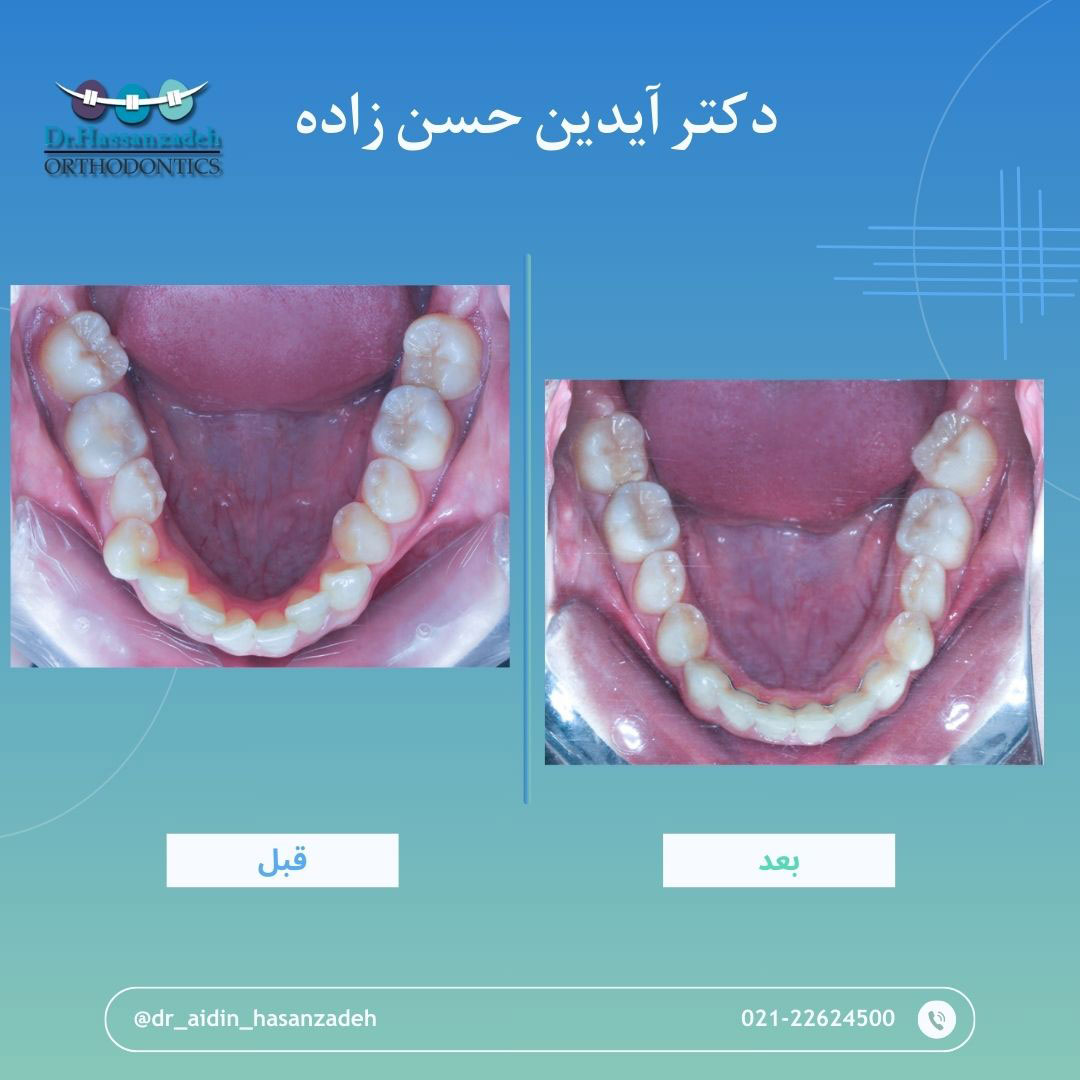 قبل و بعد از درمان اورتودنسی