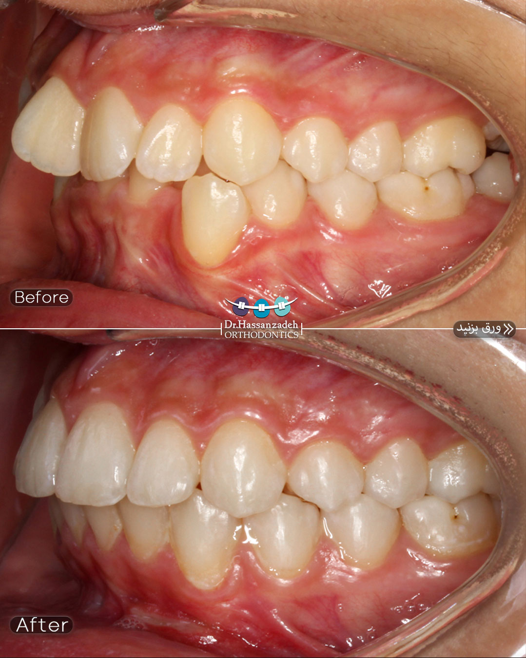 قبل و بعد از درمان اورتودنسی