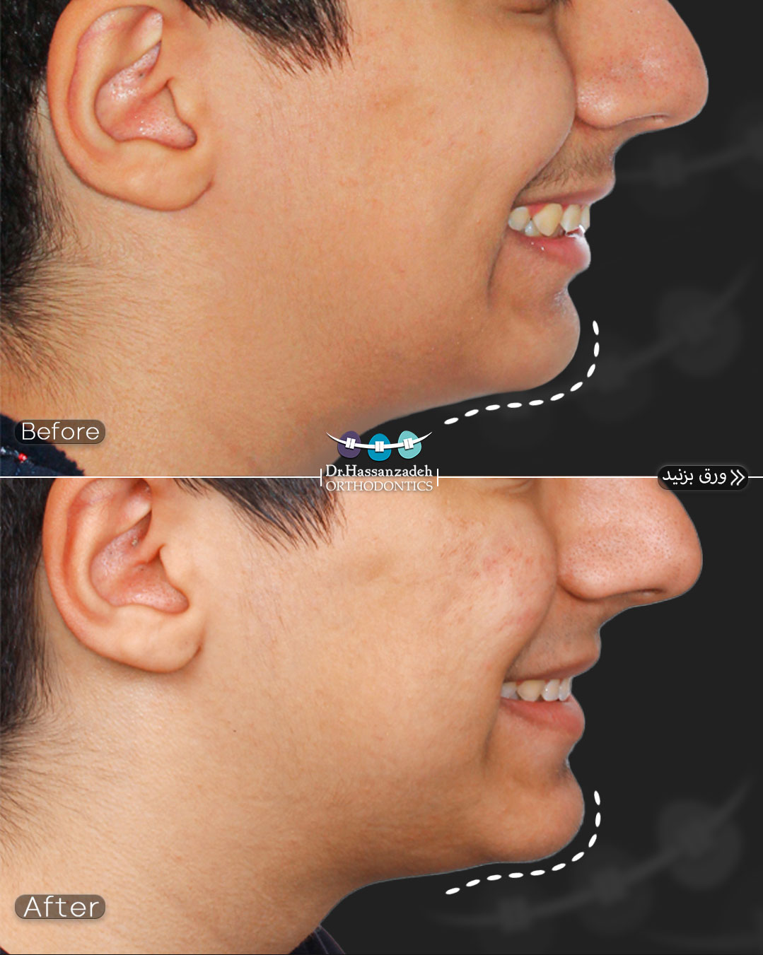 قبل و بعد از درمان اورتودنسی