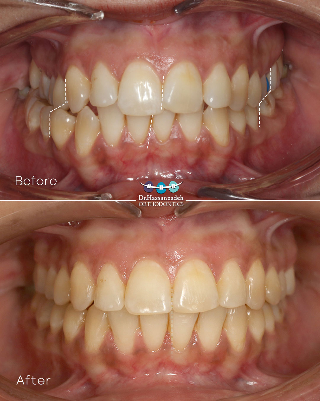 قبل و بعد از درمان اورتودنسی