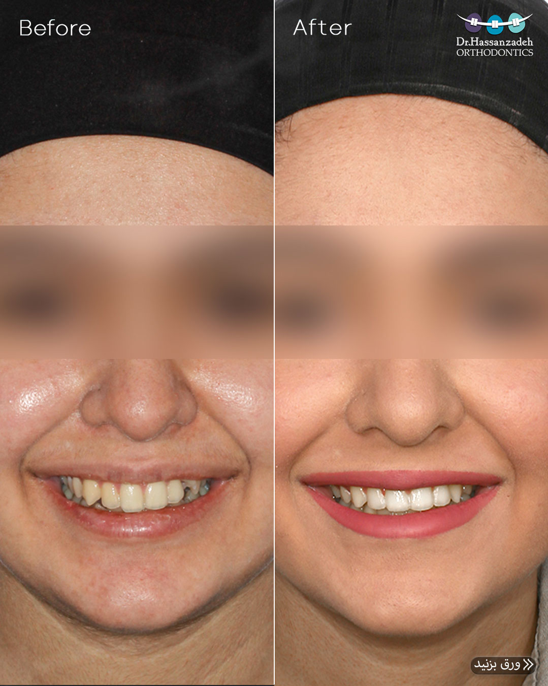 قبل و بعد از درمان