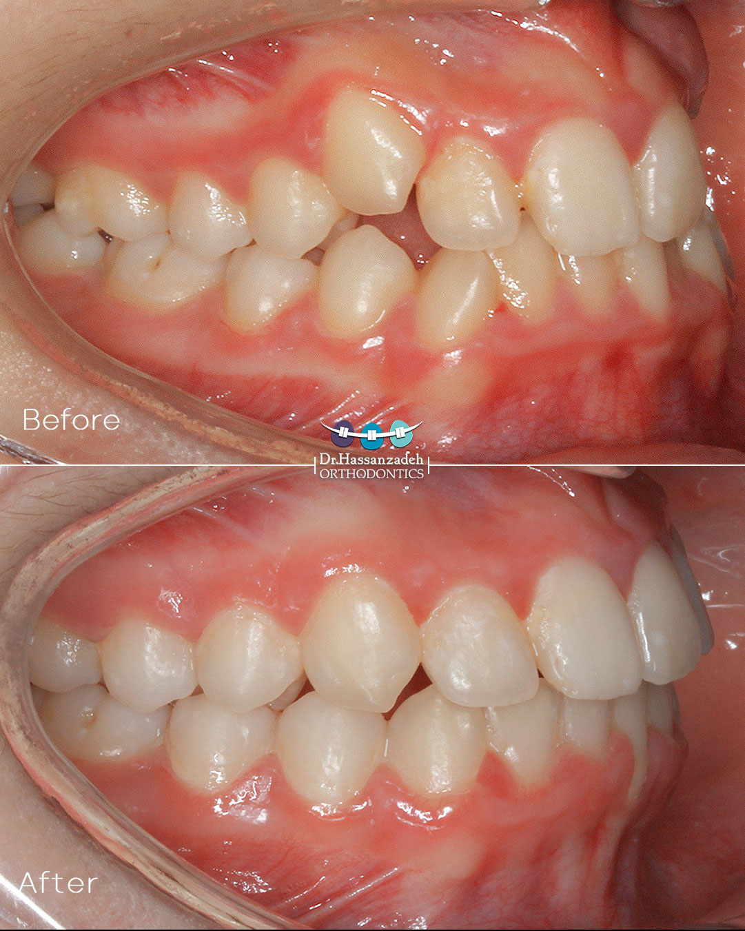 قبل و بعد از درمان اورتودنسی