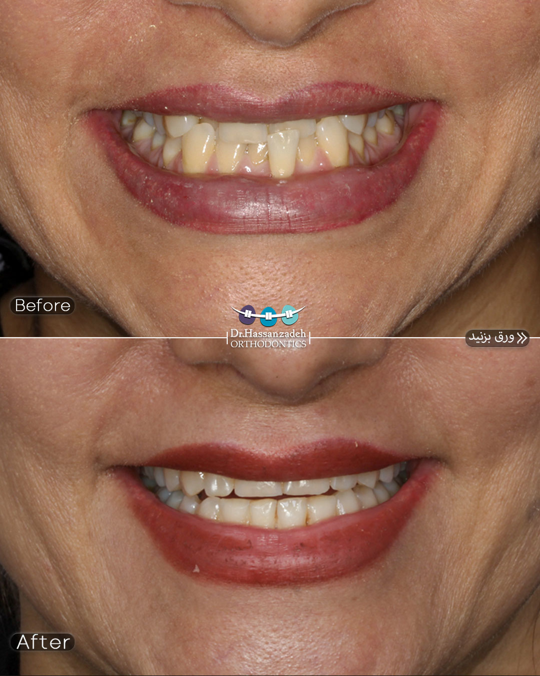 قبل و بعد از درمان اورتودنسی
