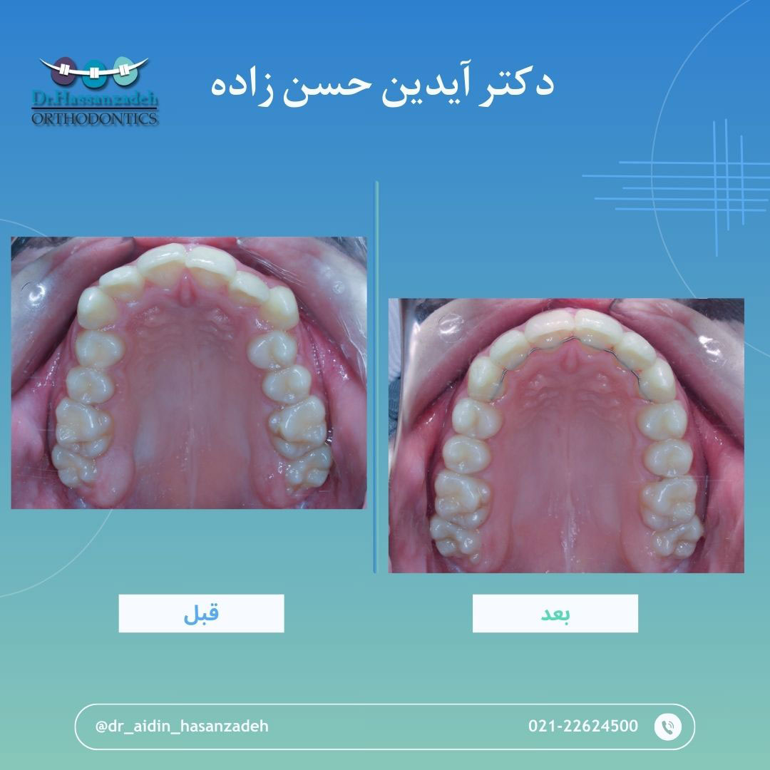 قبل و بعد از درمان اورتودنسی