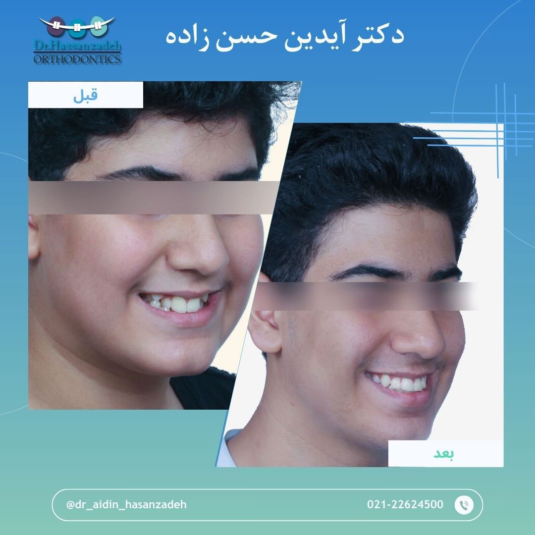 قبل و بعد از درمان اورتودنسی