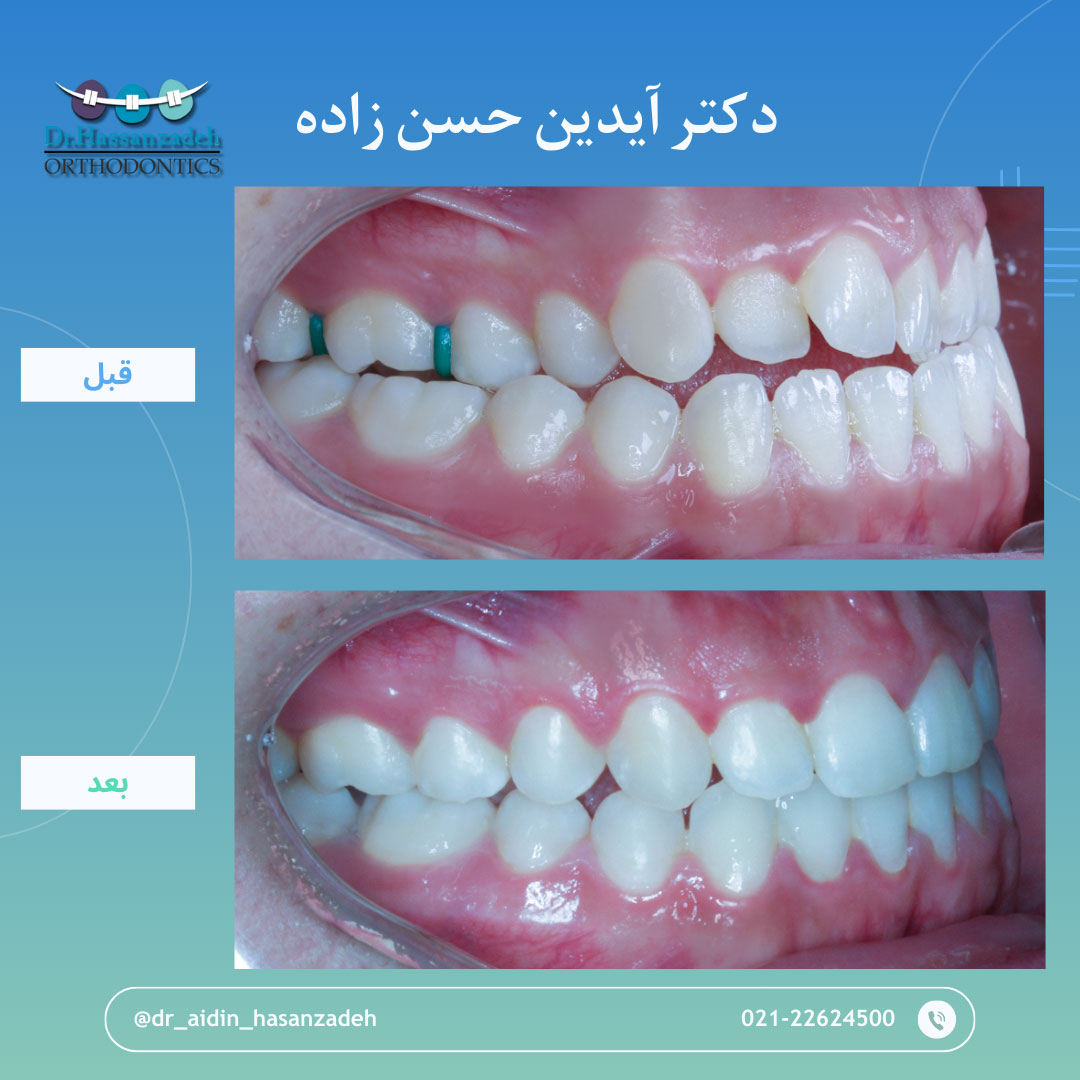 قبل و بعد از درمان اورتودنسی