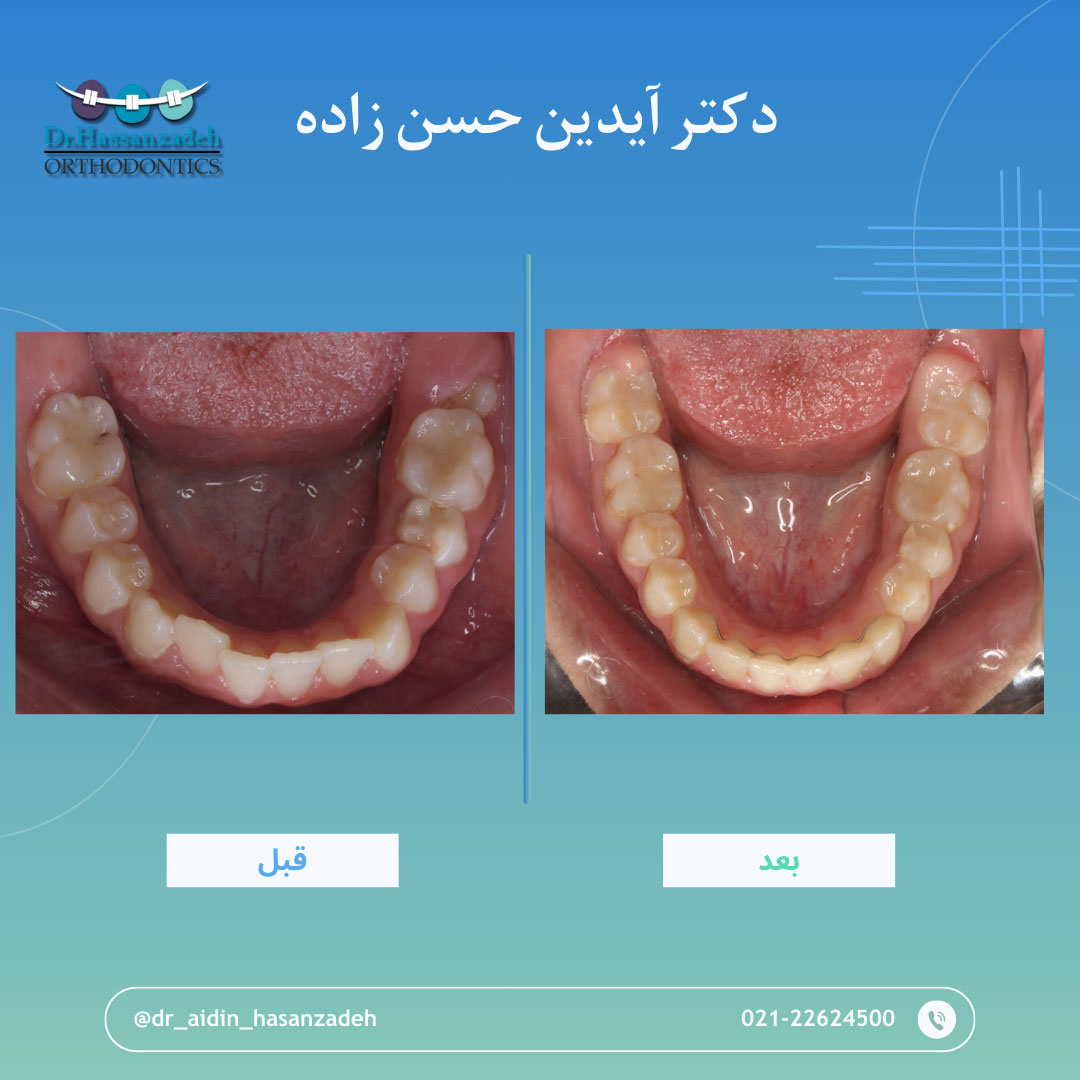 قبل و بعد از درمان اورتودنسی