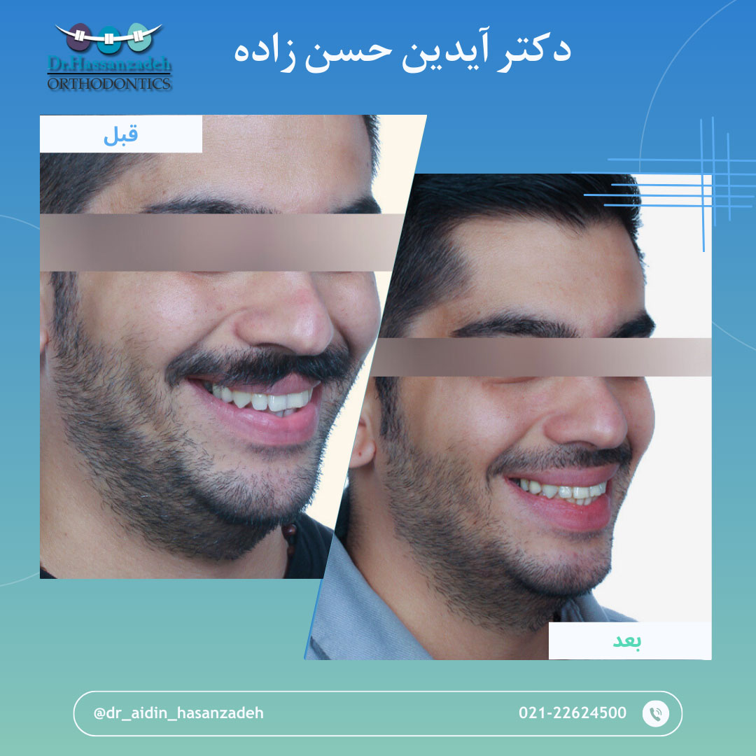 قبل و بعد از درمان اورتودنسی