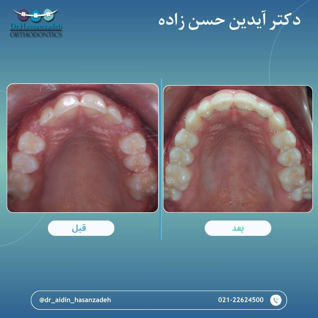 قبل و بعد از درمان اورتودنسی