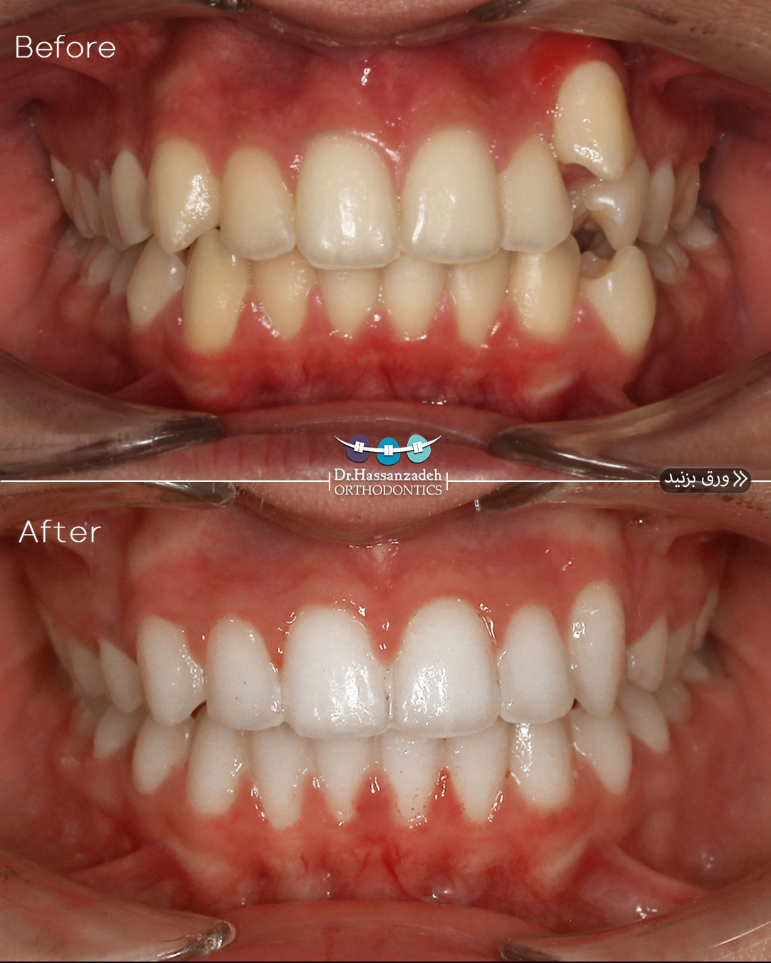 قبل و بعد از درمان اورتودنسی