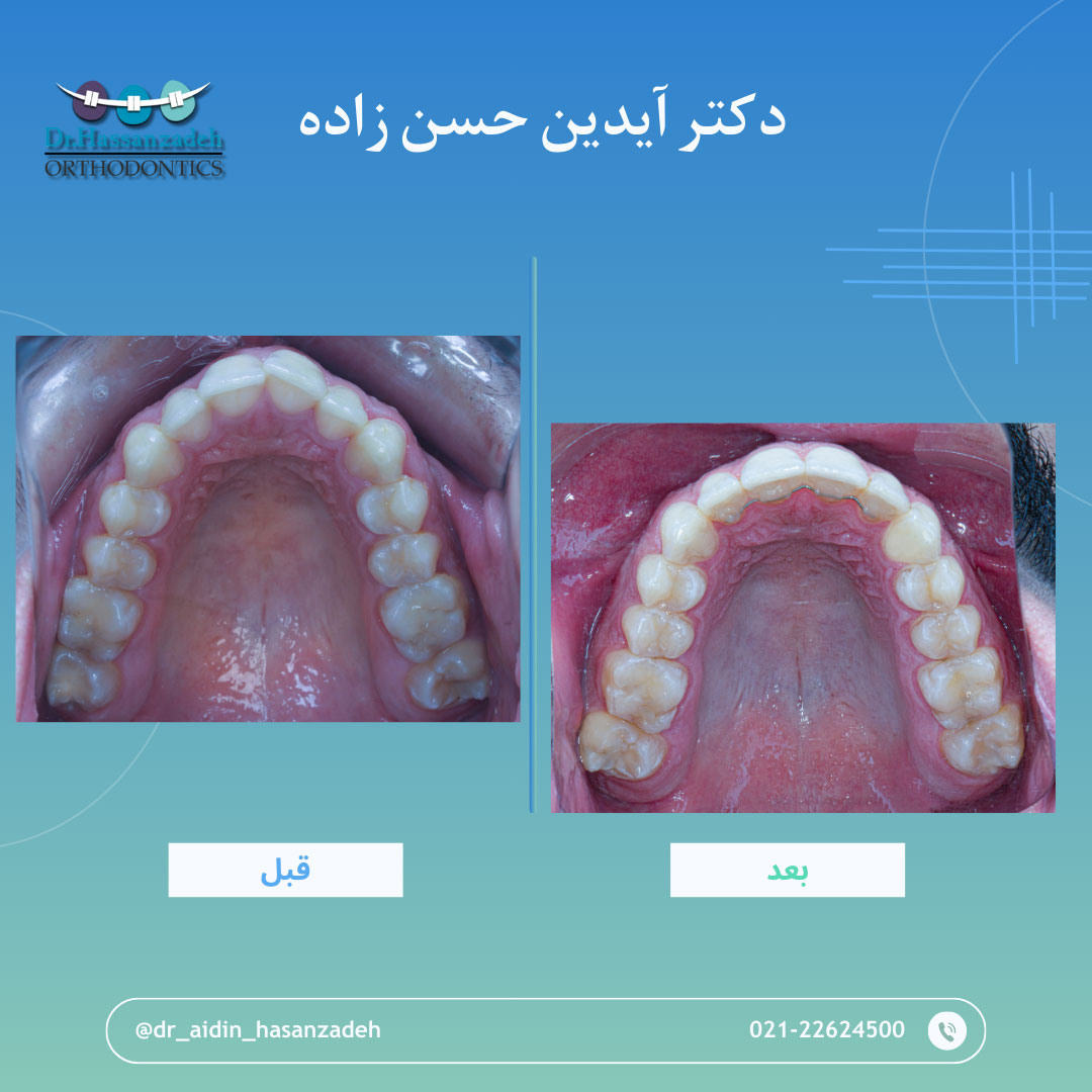 قبل و بعد از درمان اورتودنسی