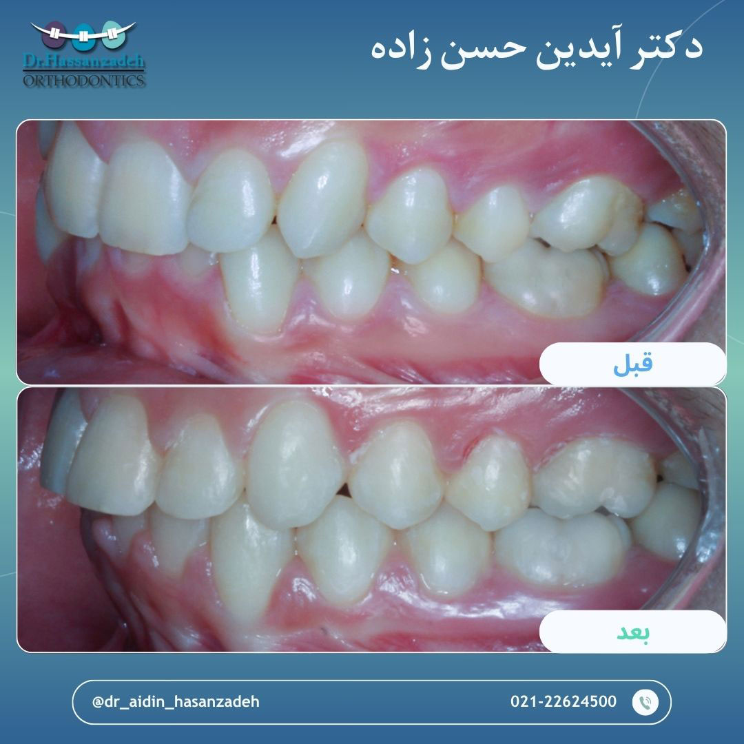 قبل و بعد از درمان اورتودنسی