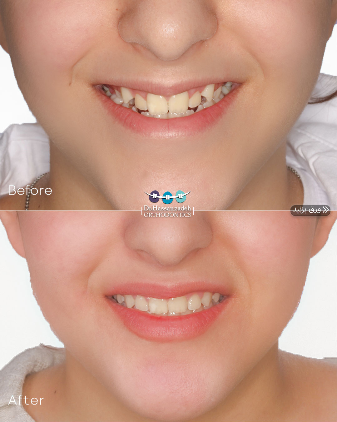 قبل و بعد از درمان اورتودنسی