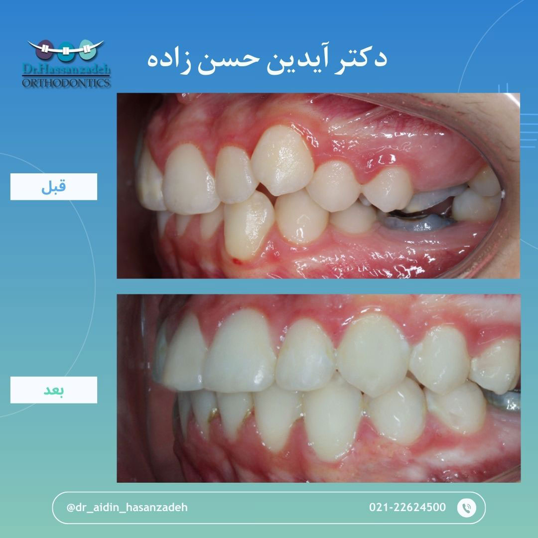 قبل و بعد از درمان اورتودنسی