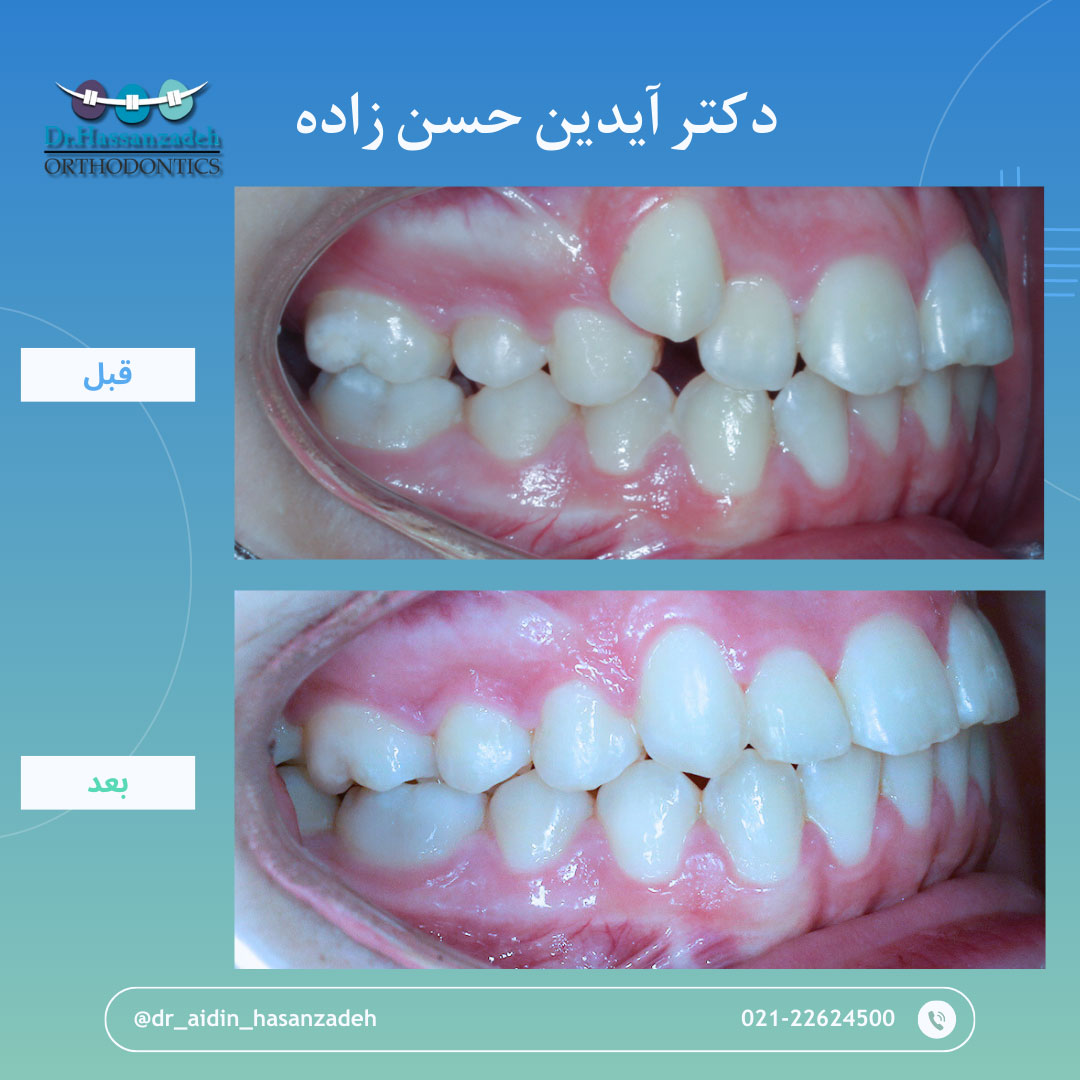 قبل و بعد از درمان اورتودنسی