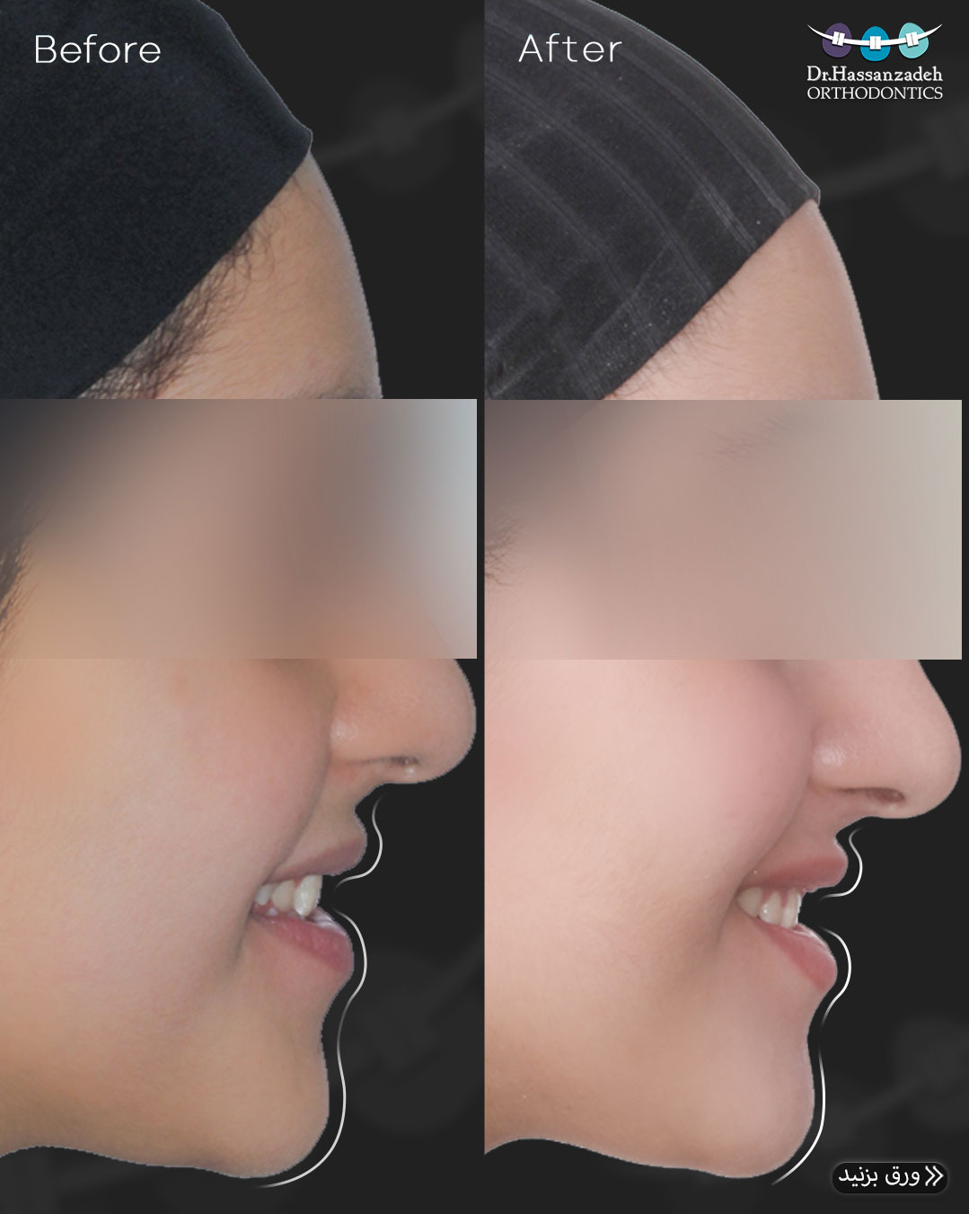 قبل و بعد از درمان اورتودنسی