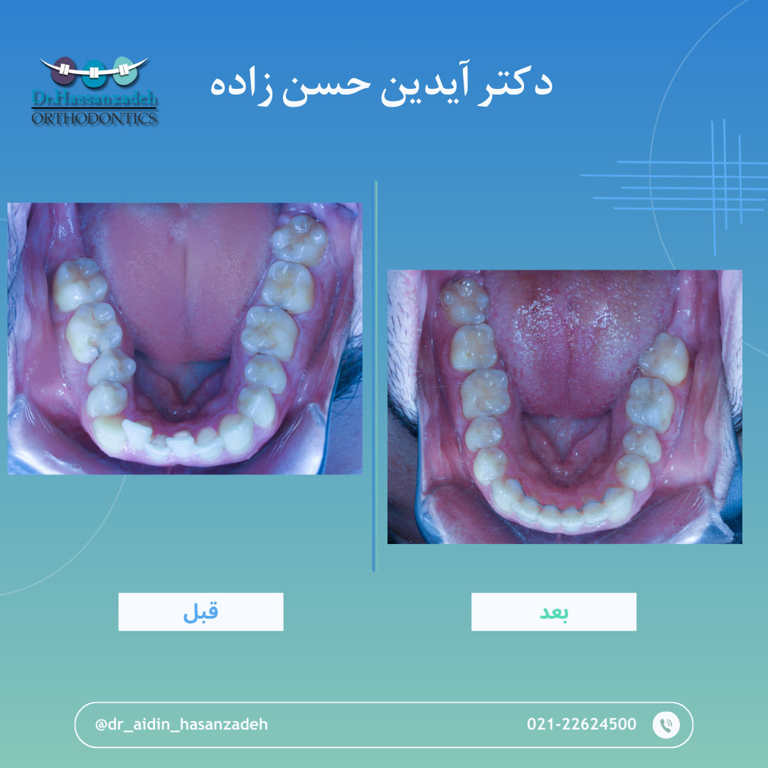 قبل و بعد از درمان اورتودنسی