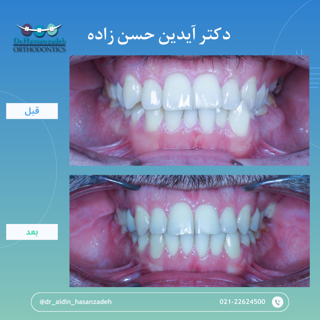 قبل و بعد از درمان اورتودنسی