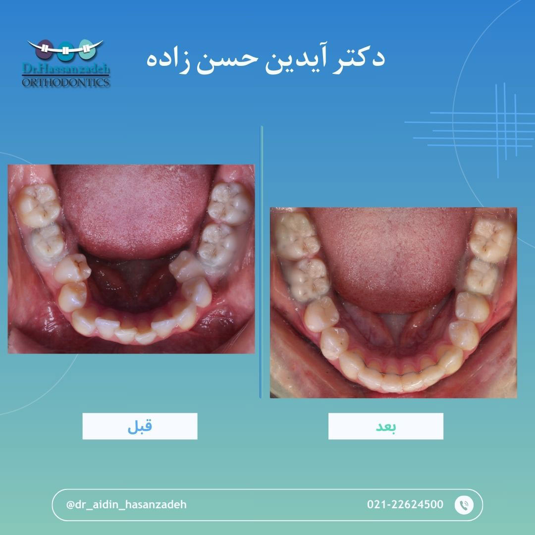 قبل و بعد از درمان اورتودنسی