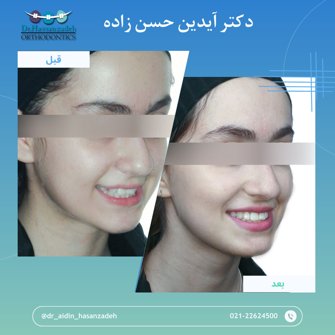 قبل و بعد از درمان اورتودنسی