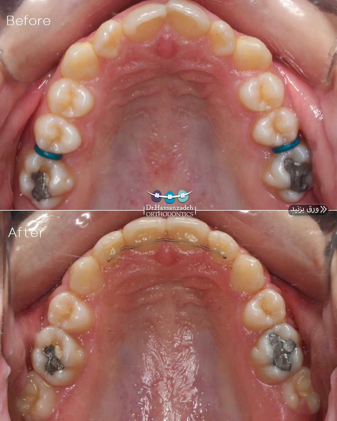 قبل و بعد از درمان اورتودنسی