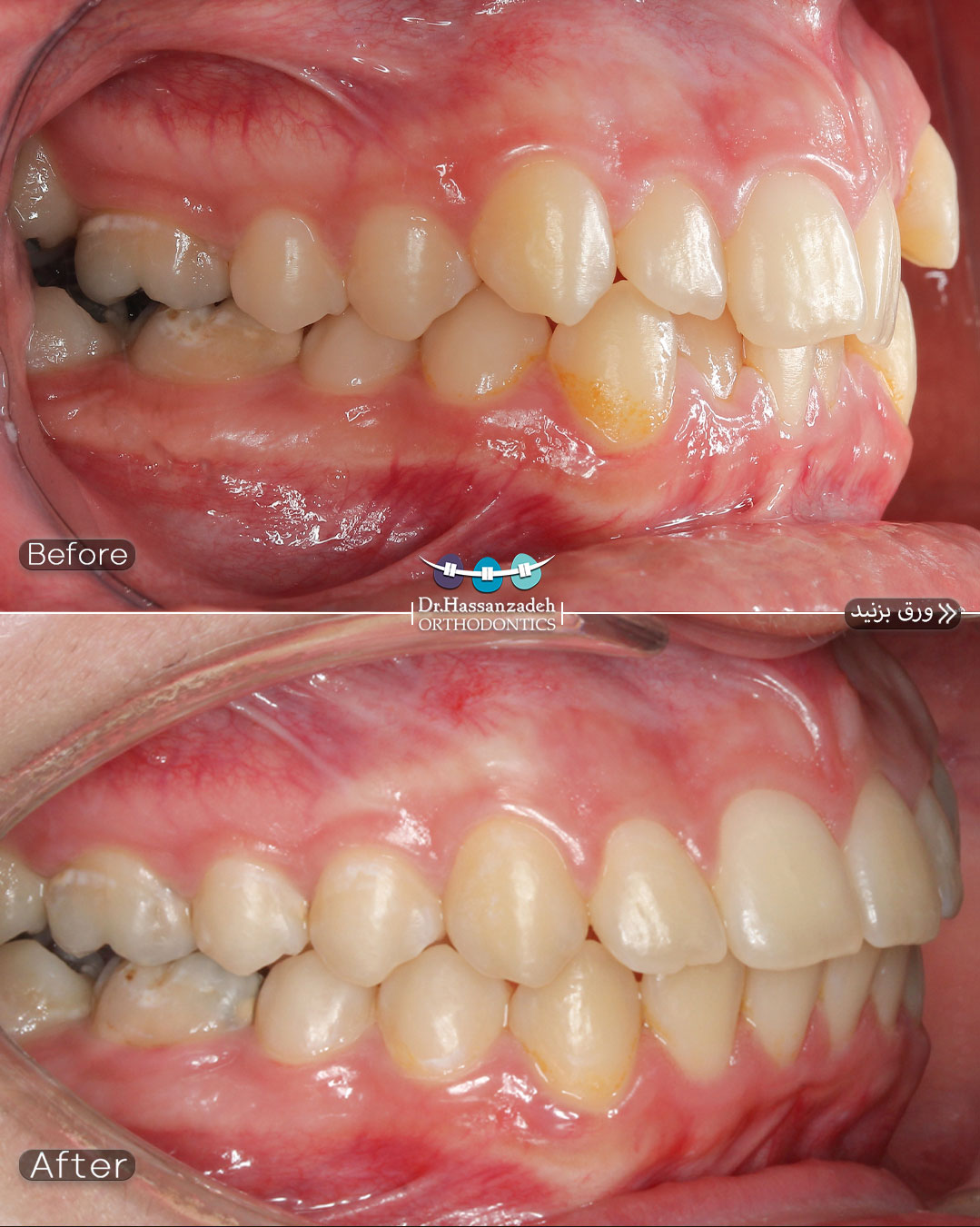 قبل و بعد از درمان اورتودنسی