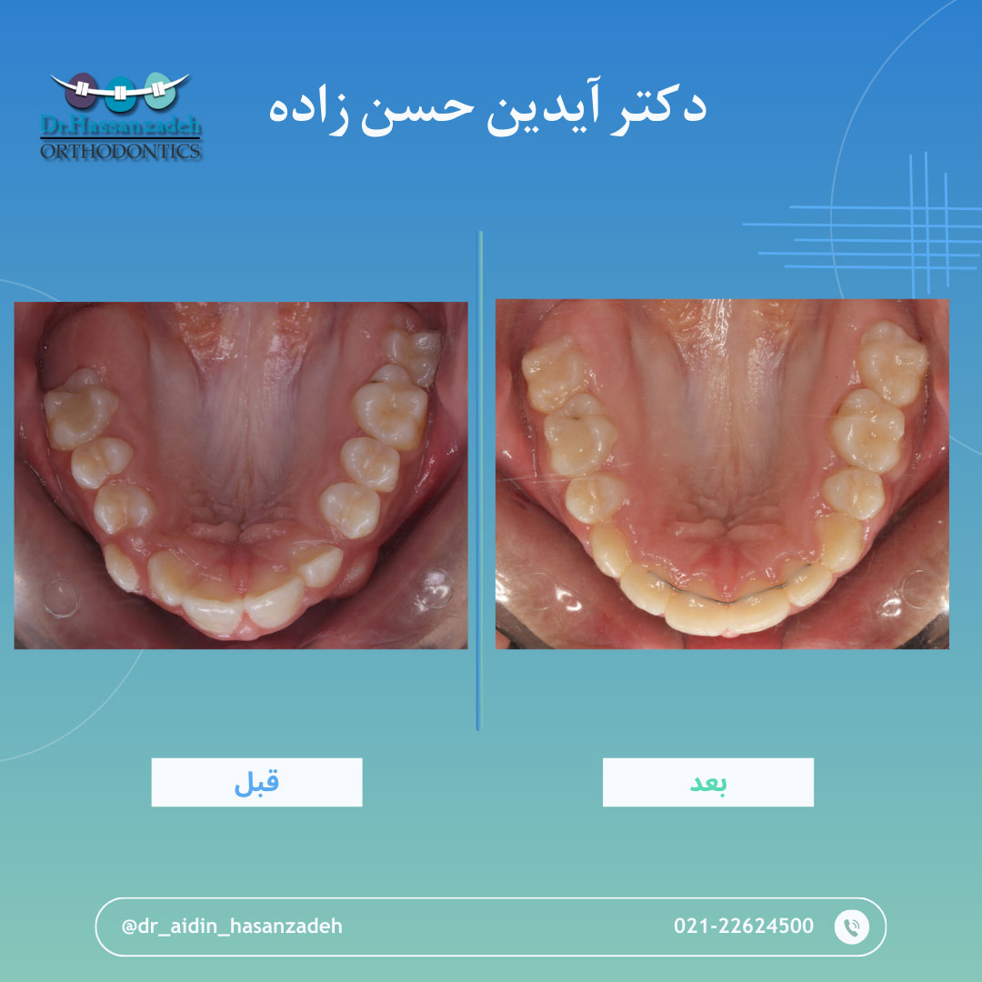 قبل و بعد از درمان اورتودنسی