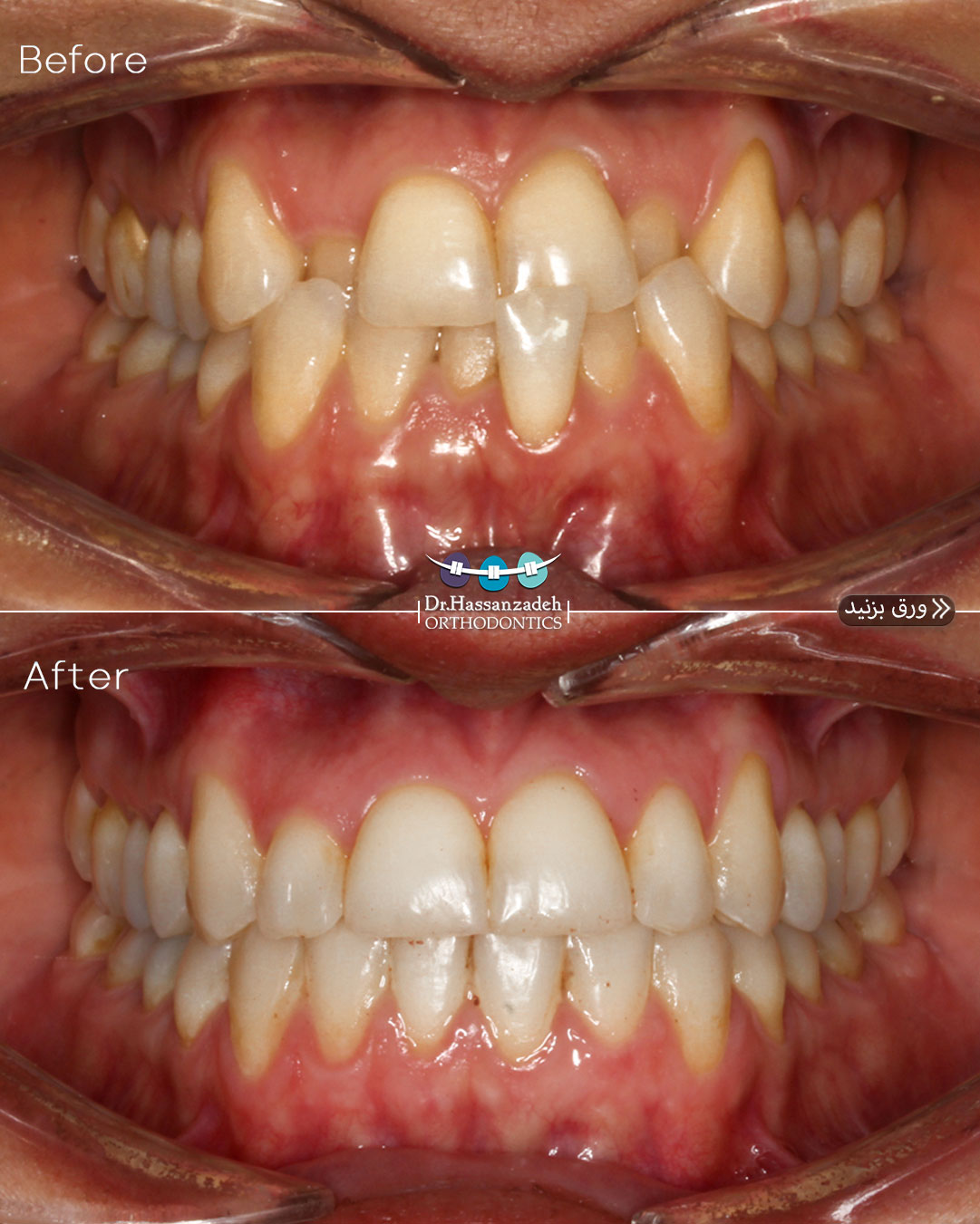قبل و بعد از درمان اورتودنسی