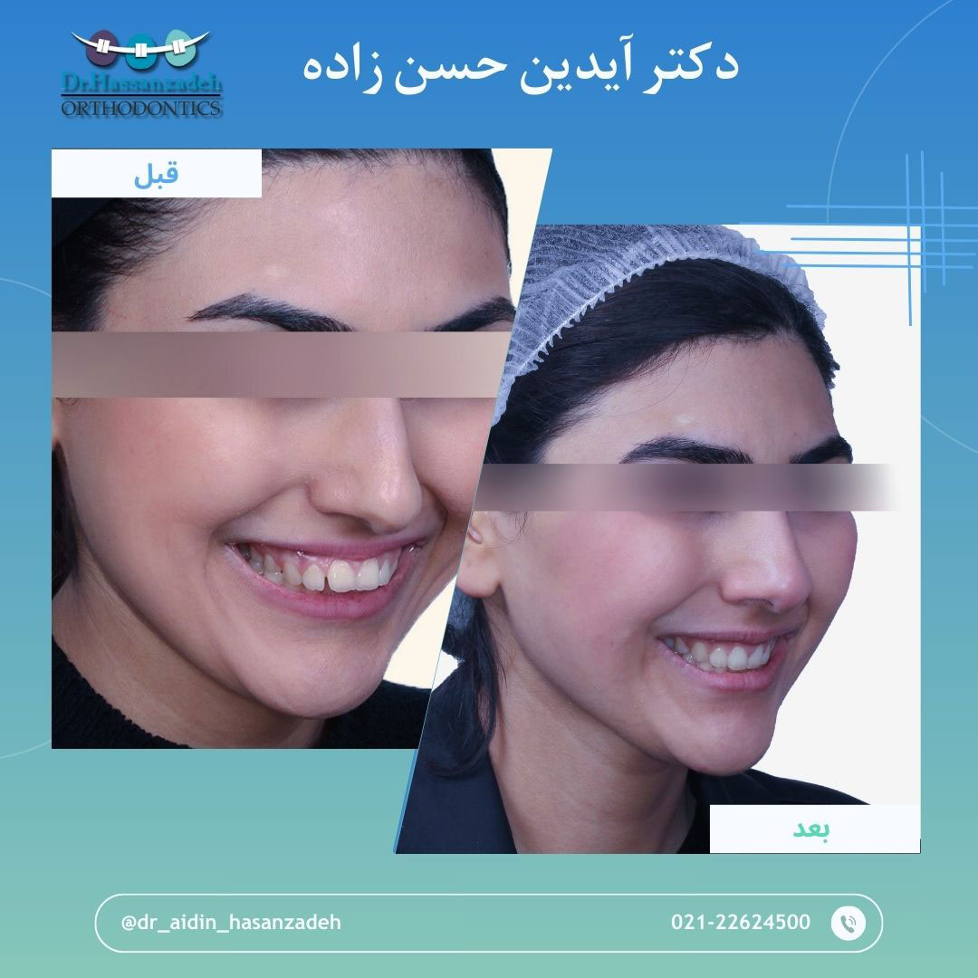 قبل و بعد از درمان اورتودنسی