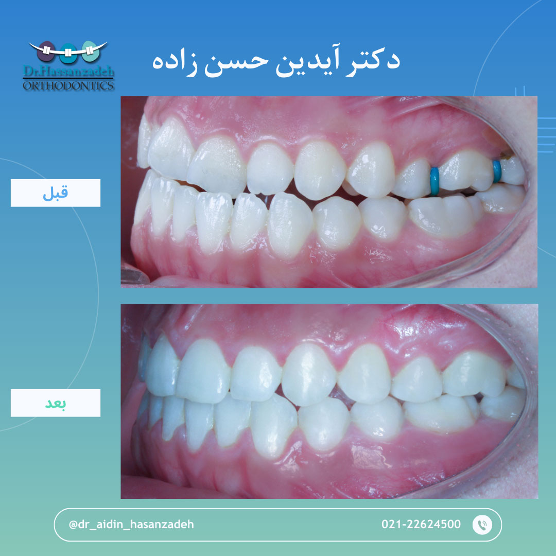قبل و بعد از درمان اورتودنسی
