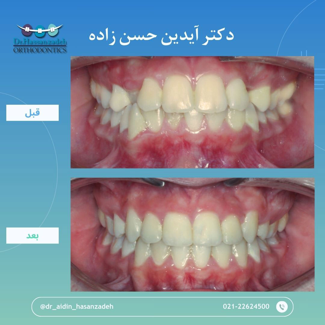 قبل و بعد از درمان اورتودنسی