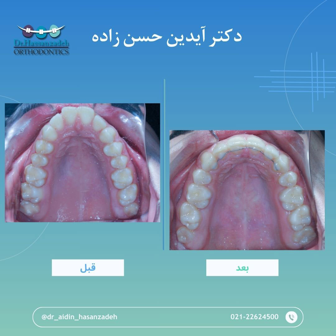 قبل و بعد از درمان اورتودنسی