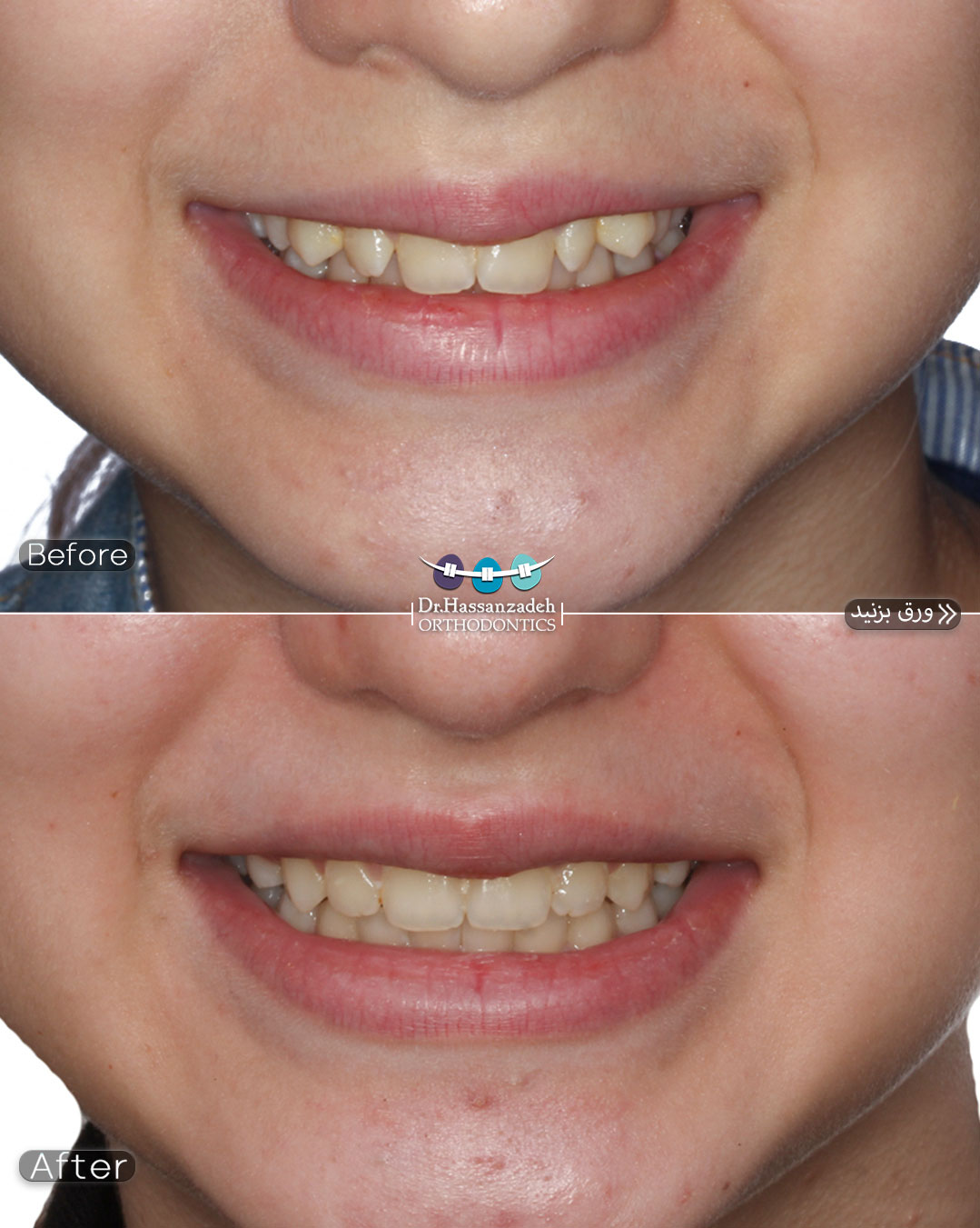 قبل و بعد از درمان اورتودنسی
