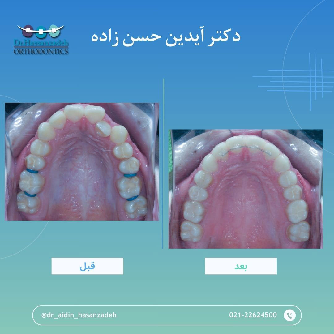 قبل و بعد از درمان اورتودنسی
