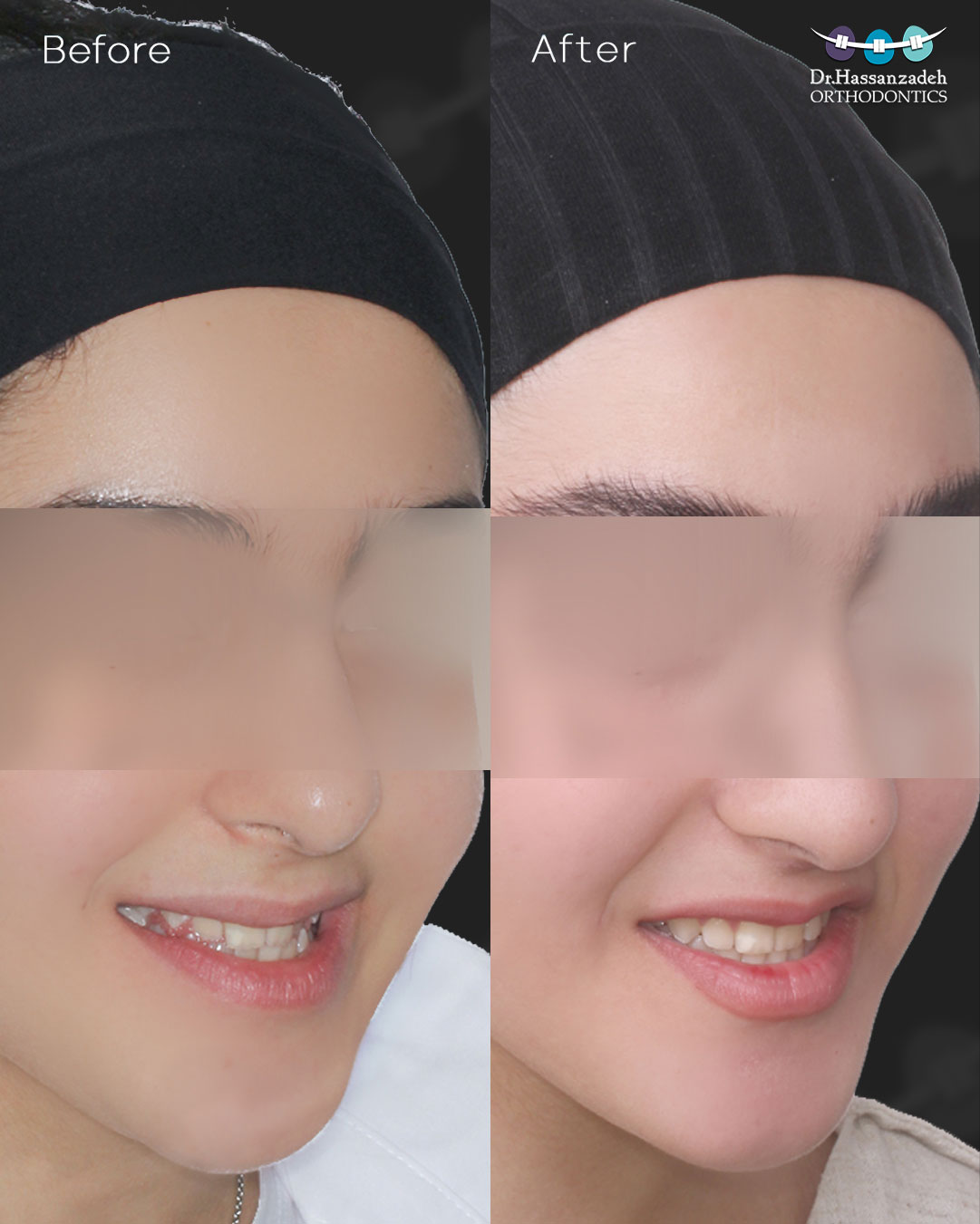 قبل و بعد از درمان اورتودنسی