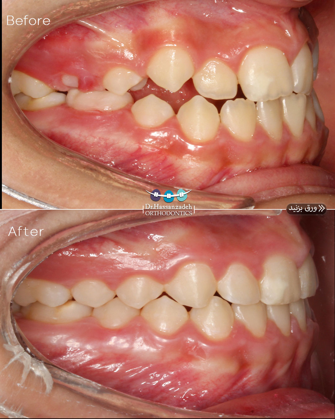 قبل و بعد از درمان اورتودنسی