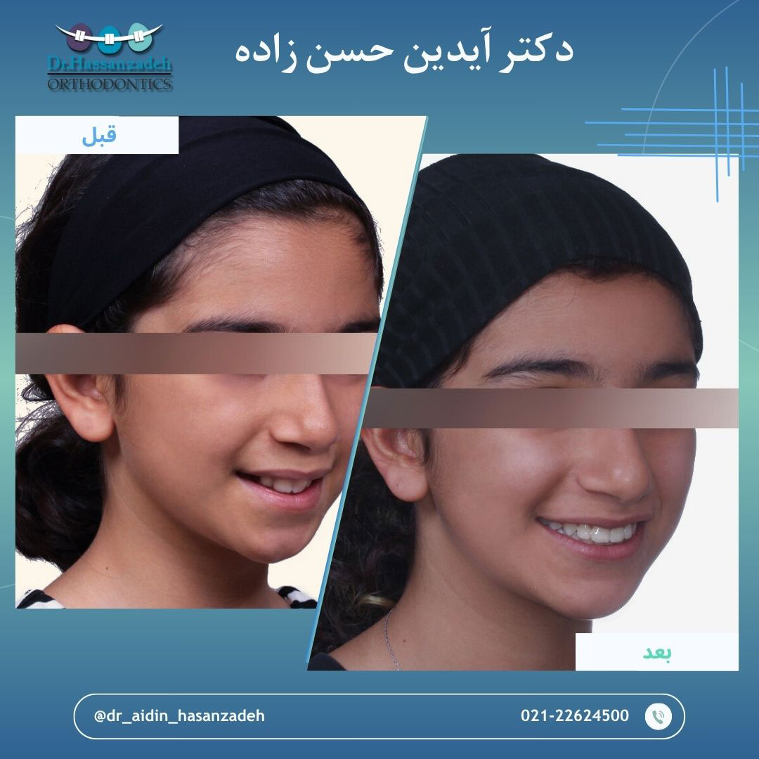 قبل و بعد از درمان اورتودنسی