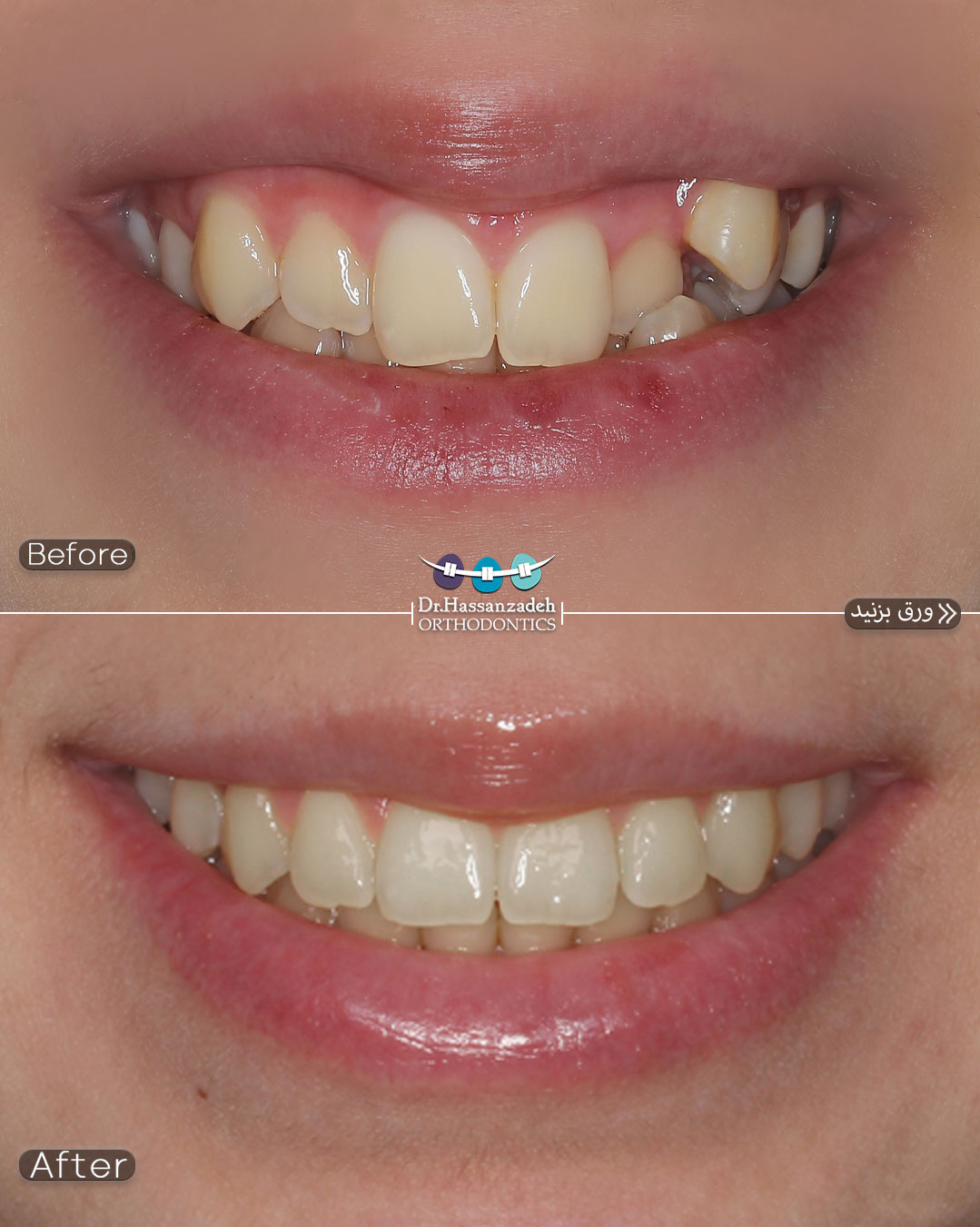 قبل و بعد از درمان اورتودنسی