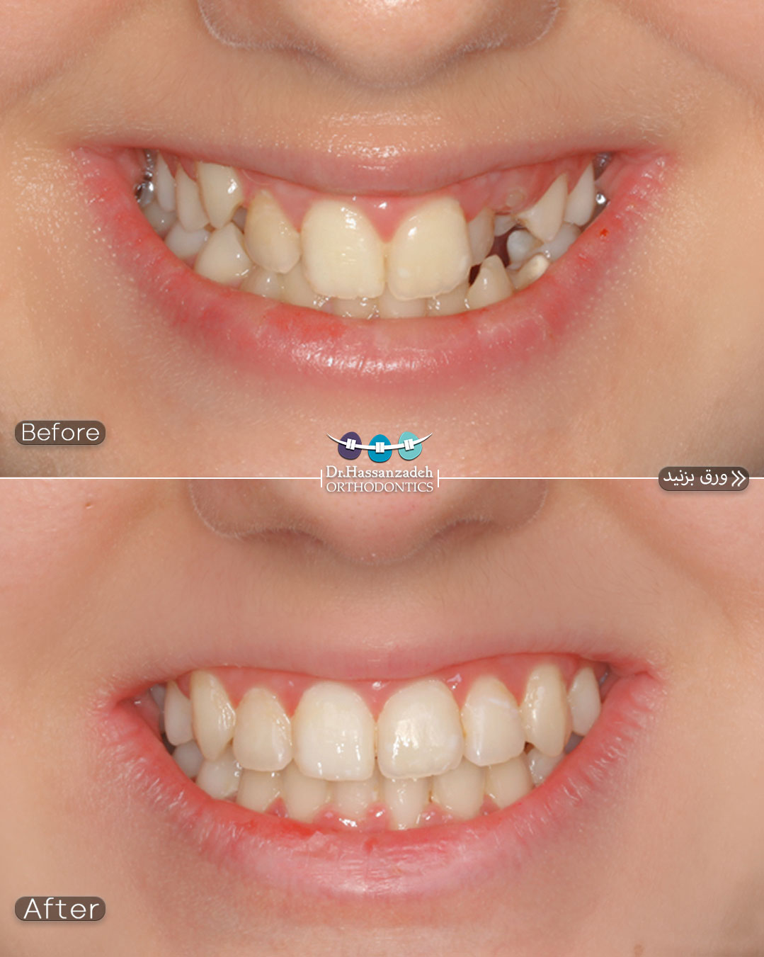 قبل و بعد از درمان اورتودنسی